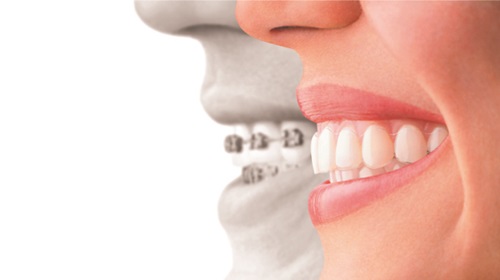 インビザライン