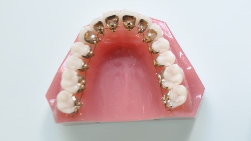 裏側ワイヤー矯正